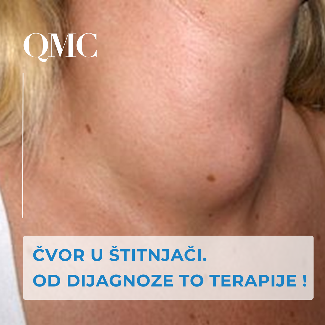 Čvorovi na štitnjači – simptomi i liječenje