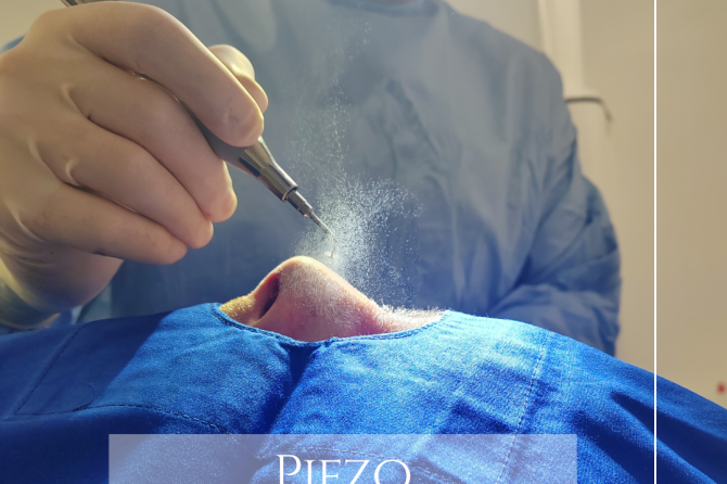 Piezo rinoplastika – inovativna i precizna korekcija nosa