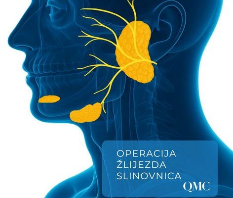 Operacija žlijezda slinovnica | Operacija parotidne, submandibularne ili sublingvalna žlijezde | QMC