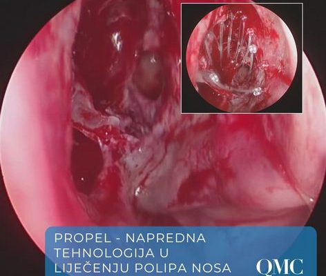 PROPEL implantat za sinuse | Revolucija u liječenju kroničnog sinusitisa | QMC