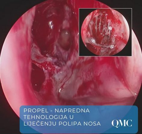 PROPEL implantat za sinuse | Revolucija u liječenju kroničnog sinusitisa | QMC