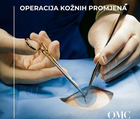 Kirurško liječenje promjena na koži – što trebate znati | QMC