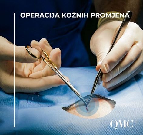 Kirurško liječenje kožnih tumora