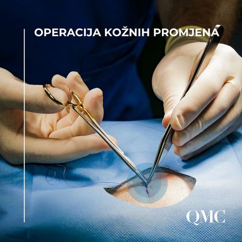 tumori-koze-operacija-radiofrekvencija-kriokirurgija