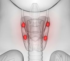 Hiperparatireoidizam (dobroćudni tumori doštitnih žlijezda)
