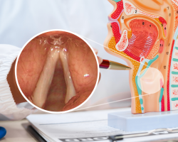 Atrofija i pseudosulkus glasnica – medicinski prikaz i endoskopska fotografija.