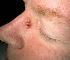 Bazocelularni karcinom