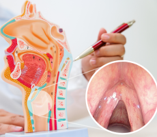 Model ljudskog grla i fotografija leukoplakije glasnica s bijelim naslagama na glasnicama.