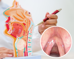 Model ljudskog grla i fotografija leukoplakije glasnica s bijelim naslagama na glasnicama.