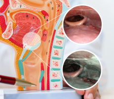 Narrow Band Imaging (NBI) prikaz grkljana i ždrijela uz anatomski model glave i vrata