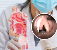 Endoskopski prikaz papilomatoze glasnica uz anatomski model grkljana