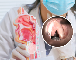 Endoskopski prikaz papilomatoze glasnica uz anatomski model grkljana