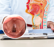 Model grkljana i endoskopski prikaz planocelularnog karcinoma glasnica