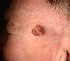 Planocelularni karcinom koze