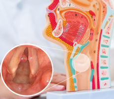 Anatomski model grkljana i endoskopski prikaz polipa na glasnicama