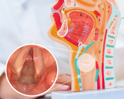 Anatomski model grkljana i endoskopski prikaz polipa na glasnicama