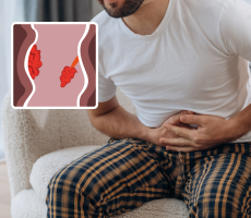 Tumori analne regije