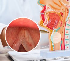 Medicinski model grkljana s prikazom Reinkeovog edema glasnica uvećanom fotografijom