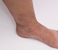 Komplikacije bolesti vena nogu