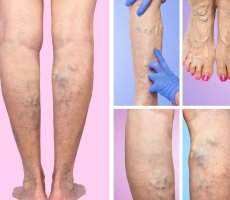Proširene vene nogu - varikoziteti